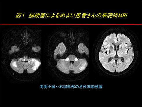 図1 脳梗塞によるめまい患者さんの来院時MRI