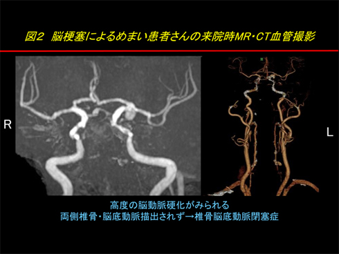 図2 脳梗塞によるめまい患者さんの来院時MR・CT血管撮影